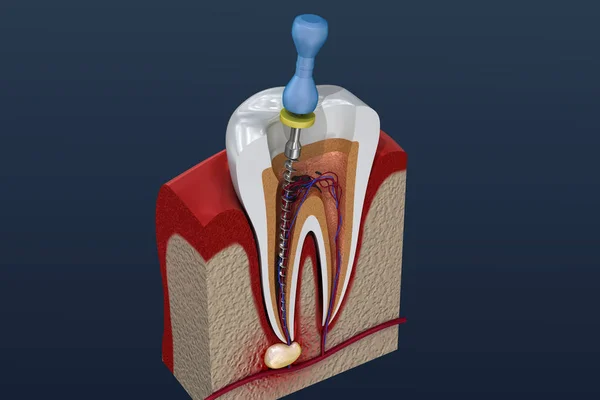 canal-treatment-process-illustration