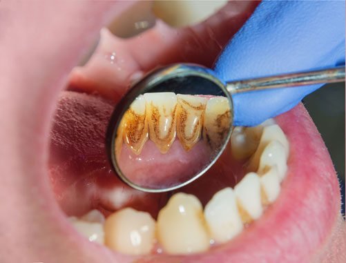 limpeza-de-dente-profilaxia
